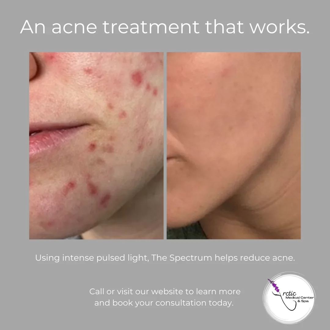 Before and after images of a person's face showing a reduction in acne, with accompanying text promoting a treatment using intense pulsed light at Ratic Medical Center & Spa.