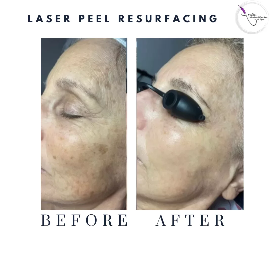 Side-by-side comparison of a woman's face showing improvements in skin texture and pigmentation before and after laser peel resurfacing. The left side, labeled 'Before,' displays aged, pigmented skin, while the right side, labeled 'After,' shows smoother, clearer skin. The logo of a cosmetic laser clinic is in the top right corner.