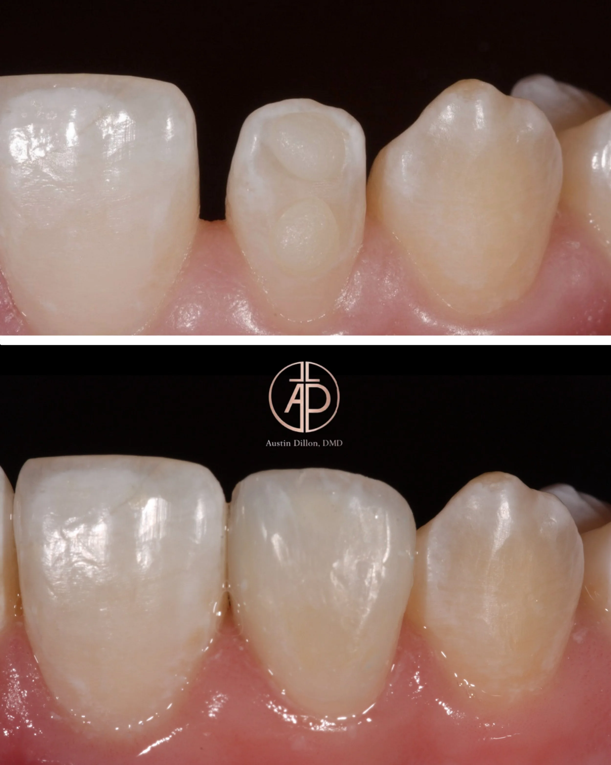 ✨Composite Bonding for Peg Laterals✨
The goal isn&rsquo;t necessarily perfection. It&rsquo;s authenticity. Every contour, texture, and detail is designed to imitate nature-not compete with it. Using the specific characteristics of that person and the