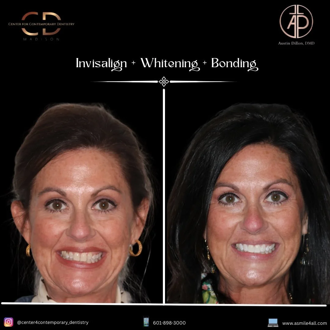 The fastest solution isn&rsquo;t always the best solution.
Sometimes moving teeth to get them in the ideal position for bonding or veneers takes time&hellip;
In aesthetics timing can certainly play a role. Weddings, graduations, photographs, and life
