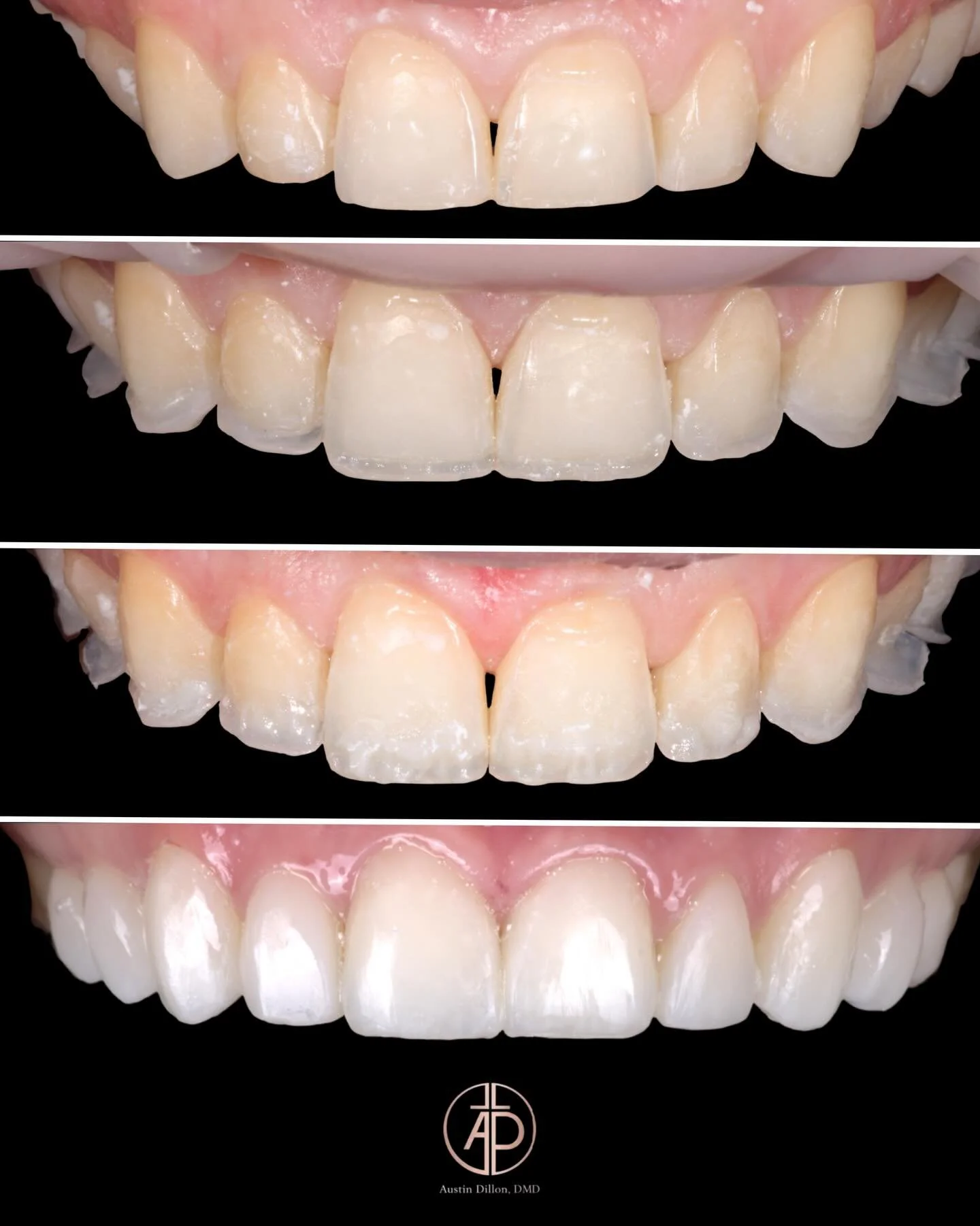 ✨ Layering with Intention ✨
Each composite is selected with purpose. By prioritizing strength, longevity, and hygiene first, you create a foundation that supports everything that follows.
From there, Beauty becomes a byproduct- not the primary goal.
