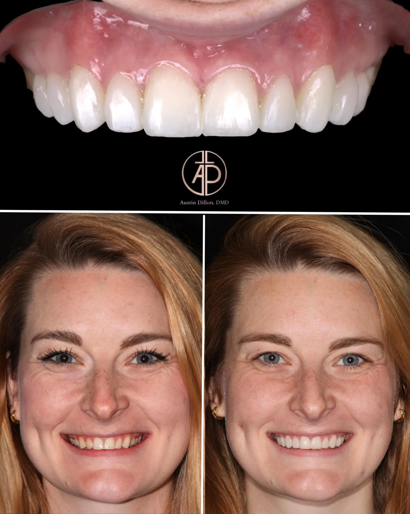 ✨10 hand-layered composite veneers following Invisalign✨
By focusing on both micro-esthetics and macro-esthetics, we were able to create a smile that fits the whole face - not just the mouth
Big thanks to @mw.ortho for the foundation that made this p