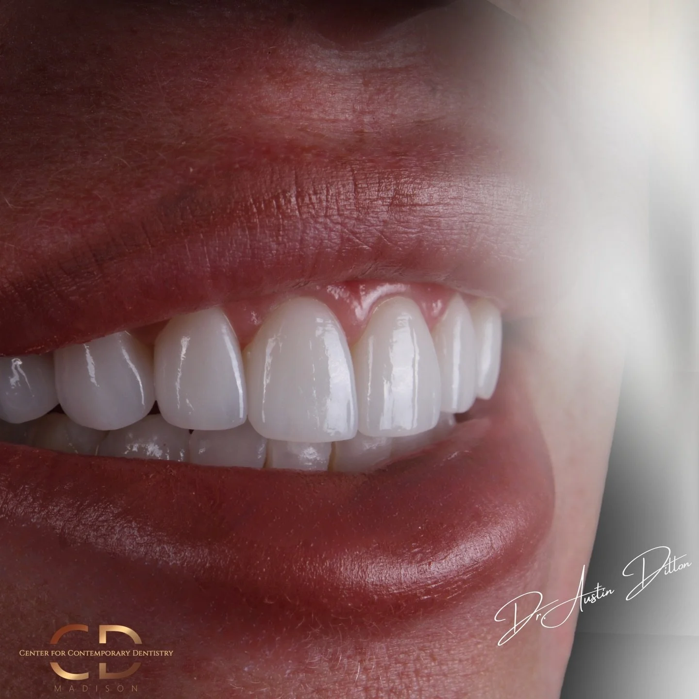 Light can be the ultimate test of veneers and crowns. How a surface reflects, absorbs, and scatters light-much like natural enamel-is what separates the SYNTHETIC from the SEAMLESS. It&rsquo;s not just about the shade; it&rsquo;s about capturing that