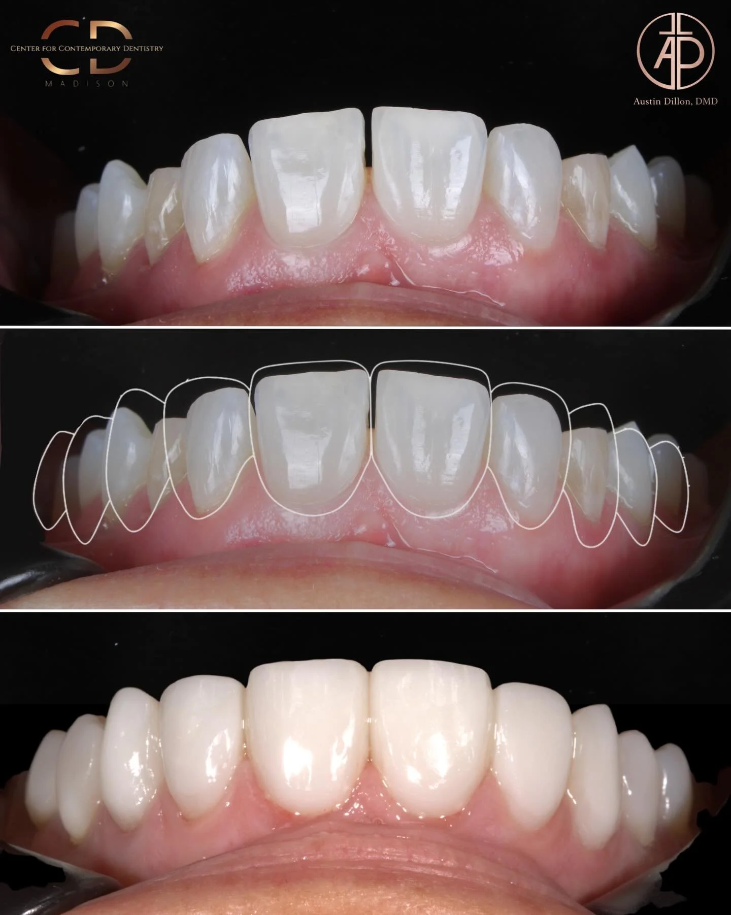 ✨Invisalign + Layered Composite Veneers✨

One treatment doesn&rsquo;t fit all patients, but the Invisalign and hand layered composite combination checked all the boxes for this case. It allowed us to place the teeth in the best place to remain as con