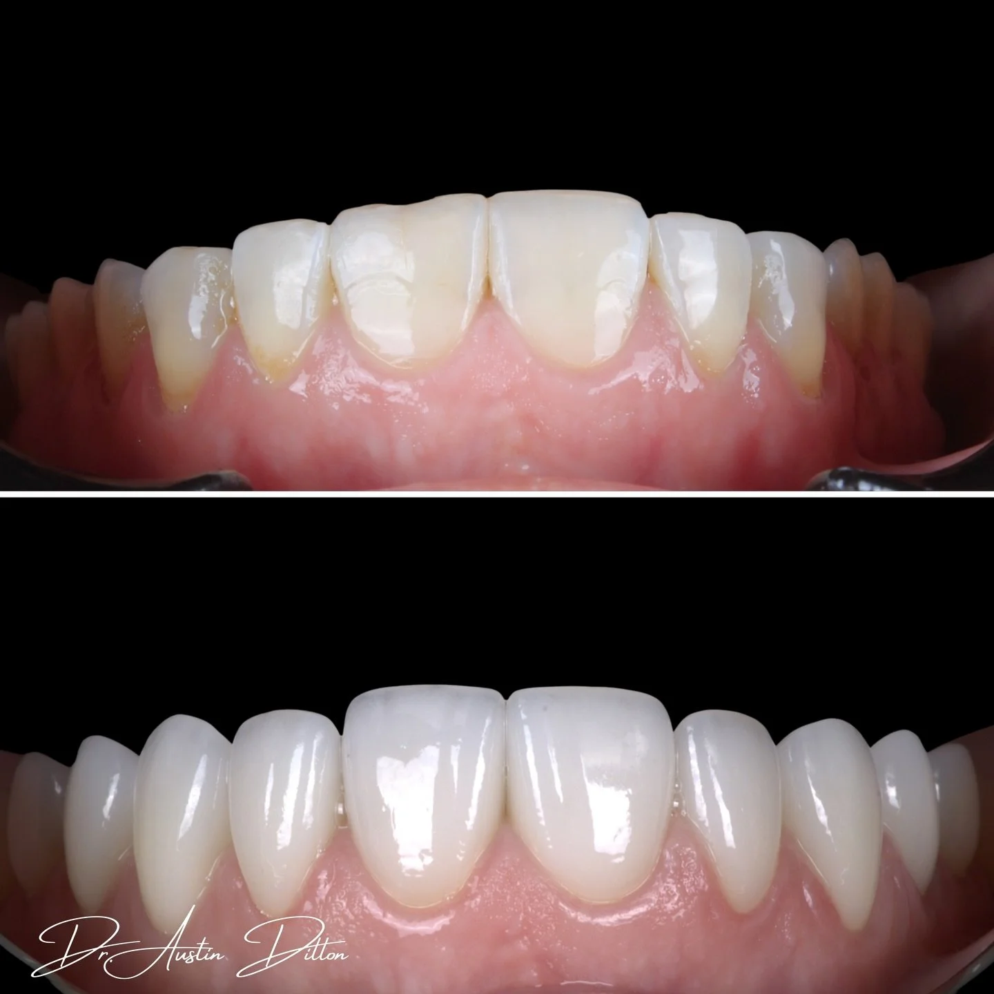 ✨Microesthetics -Up Close and Personal✨
This case combined Invisalign with veneers and crowns to re-establish proper occlusion, correct asymmetry, and widen the buccal corridor- laying the foundation for long-term function and aesthetics.

#centerfor