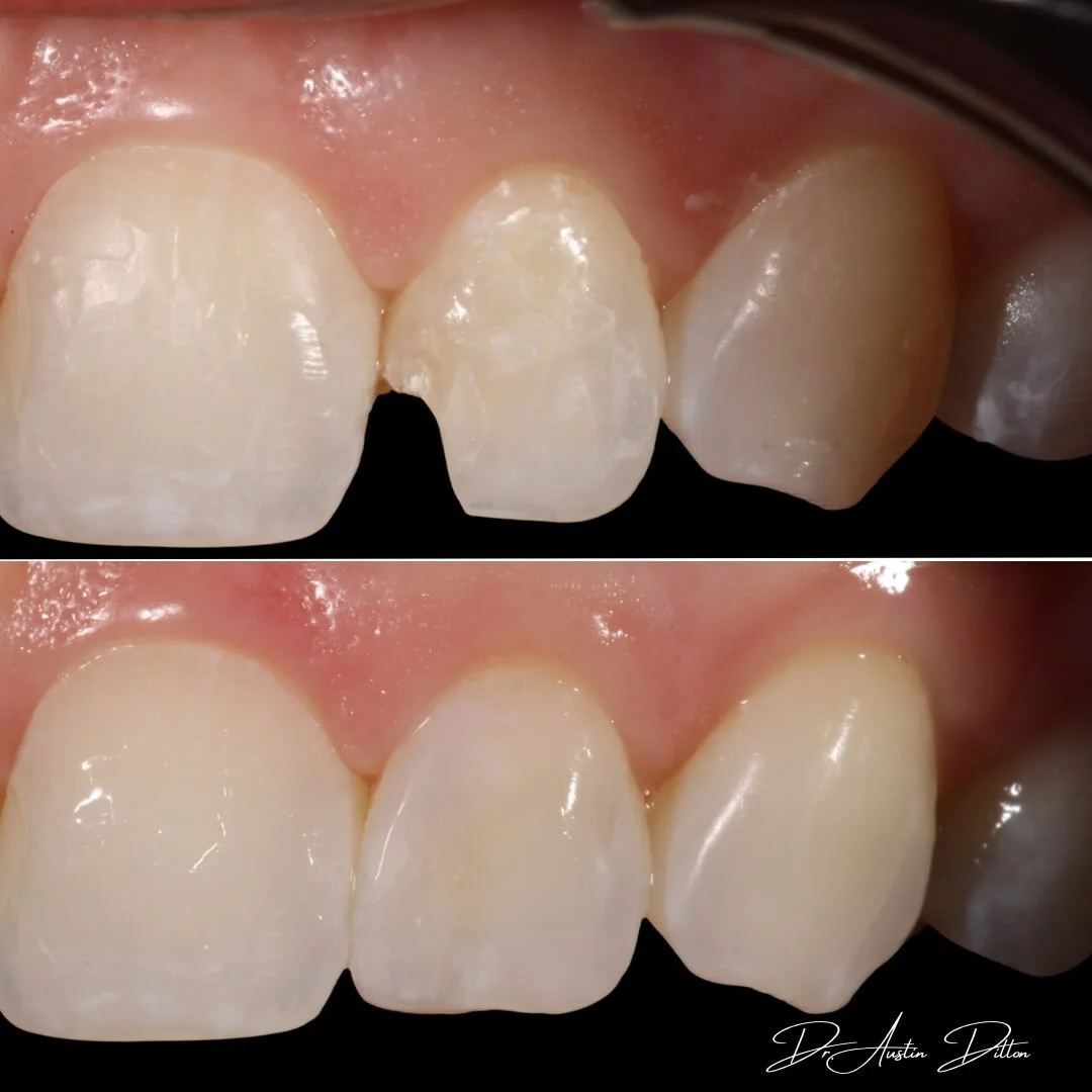 ✨Layered Composite✨
White spots, translucencies, a small notch on the edge of the tooth&hellip; it&rsquo;s the little things that set us apart.

Just like fingerprints, God designed our teeth differently in each of us. And in those details, there is 