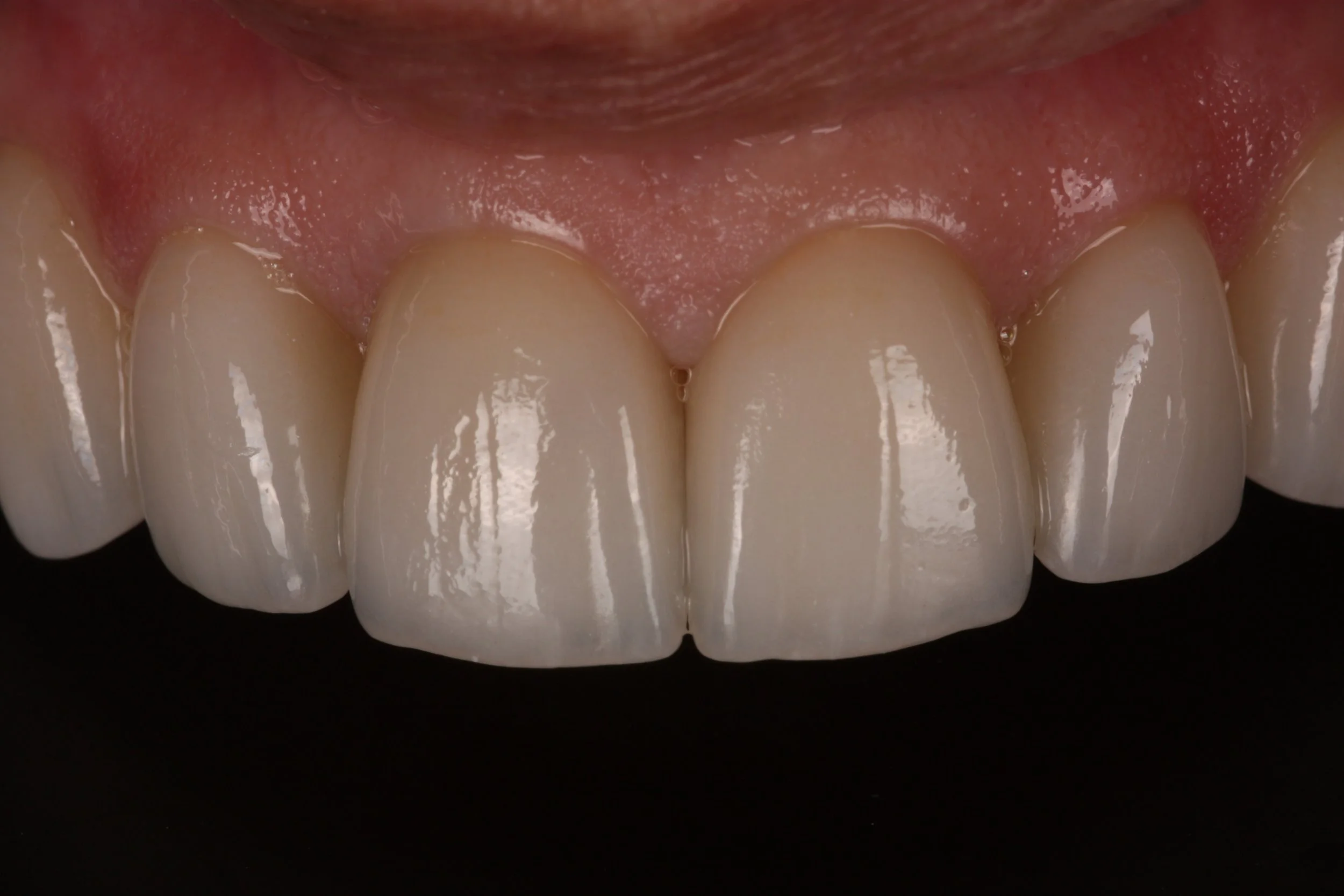 Close-up of four upper front teeth with pink gums beneath and a dark background.