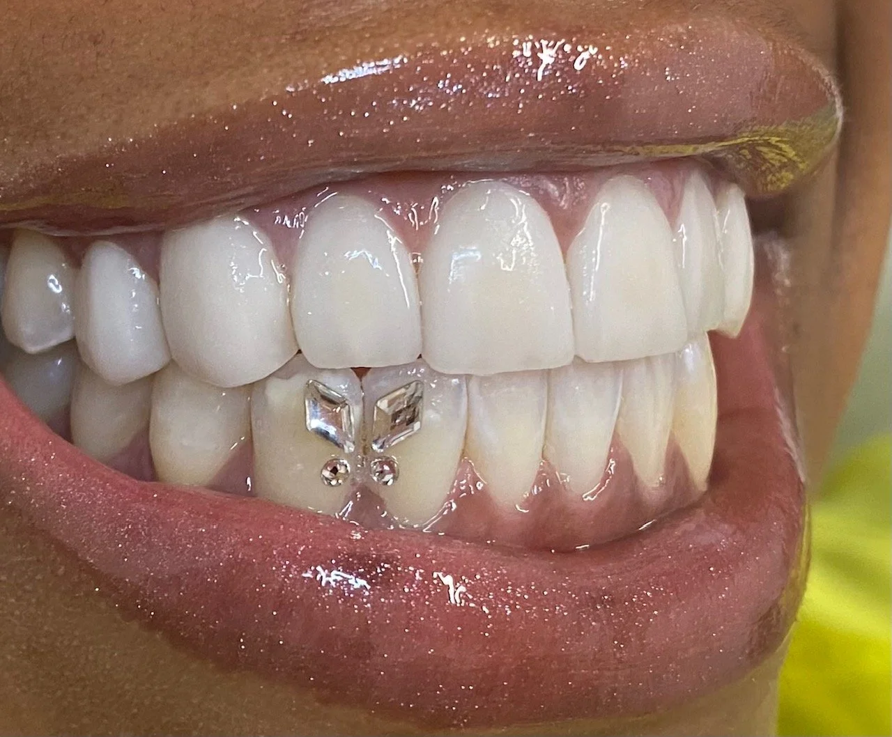 Close-up of a person's mouth showing white teeth, with a decorative dental implant on the lower front tooth