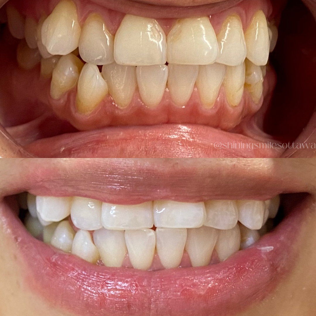 Comparison of teeth before and after cleaning, showing improvement in cleanliness and color.