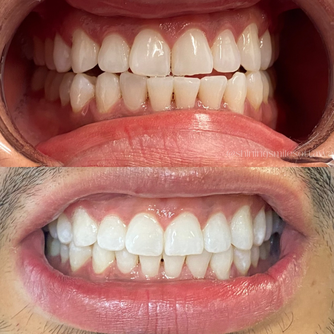 Comparison of teeth before and after dental cleaning, showing brighter, cleaner teeth in the bottom image.