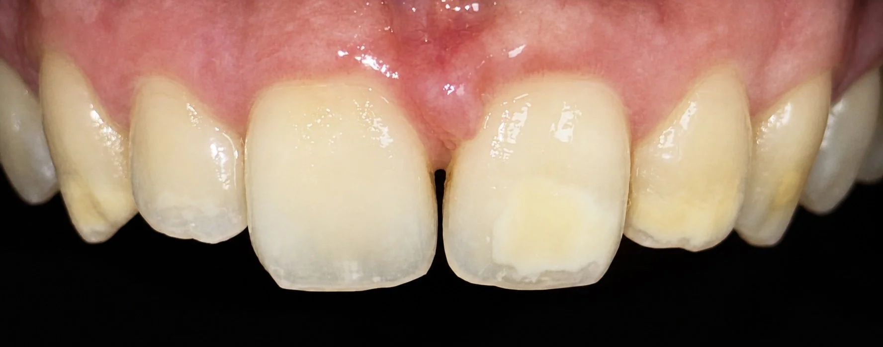 Close-up of human upper front teeth, showing signs of discoloration and minor enamel damage.