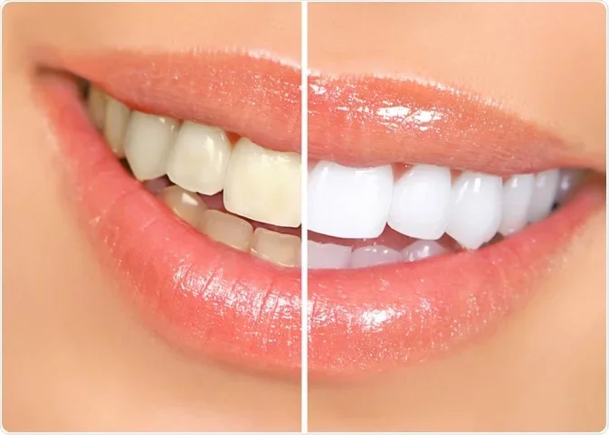 Close-up of a person's smile showing comparison of discolored teeth on the left and whiter teeth on the right.