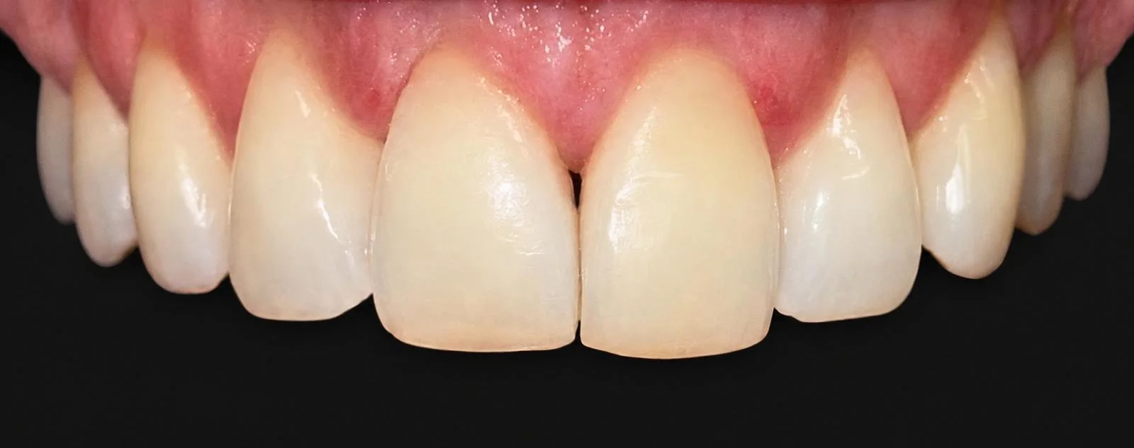 Close-up of upper front teeth and gums, showing healthy teeth with mild spacing and pink gums.