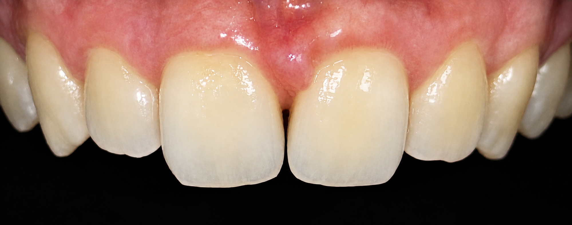 Close-up image of upper front teeth with visible gums and a small gap between the two front teeth.
