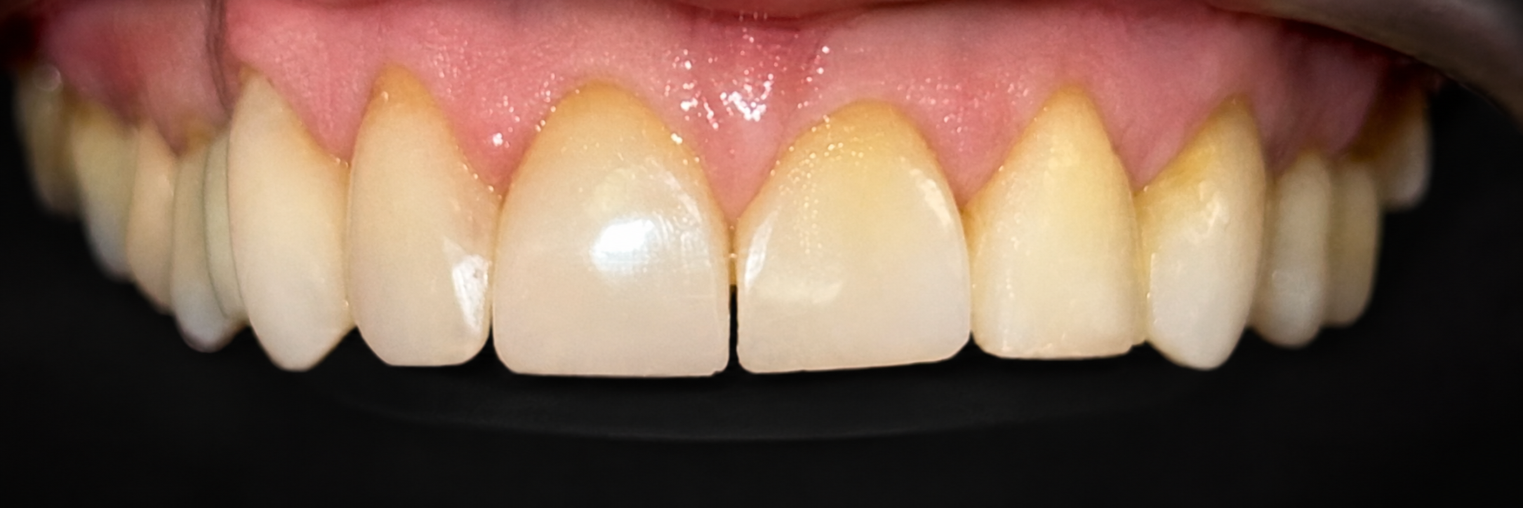 Close-up of a person's upper front teeth with some discoloration and wear, set against a black background.