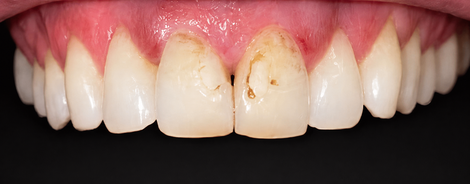 Close-up of front teeth with plaque and decay.