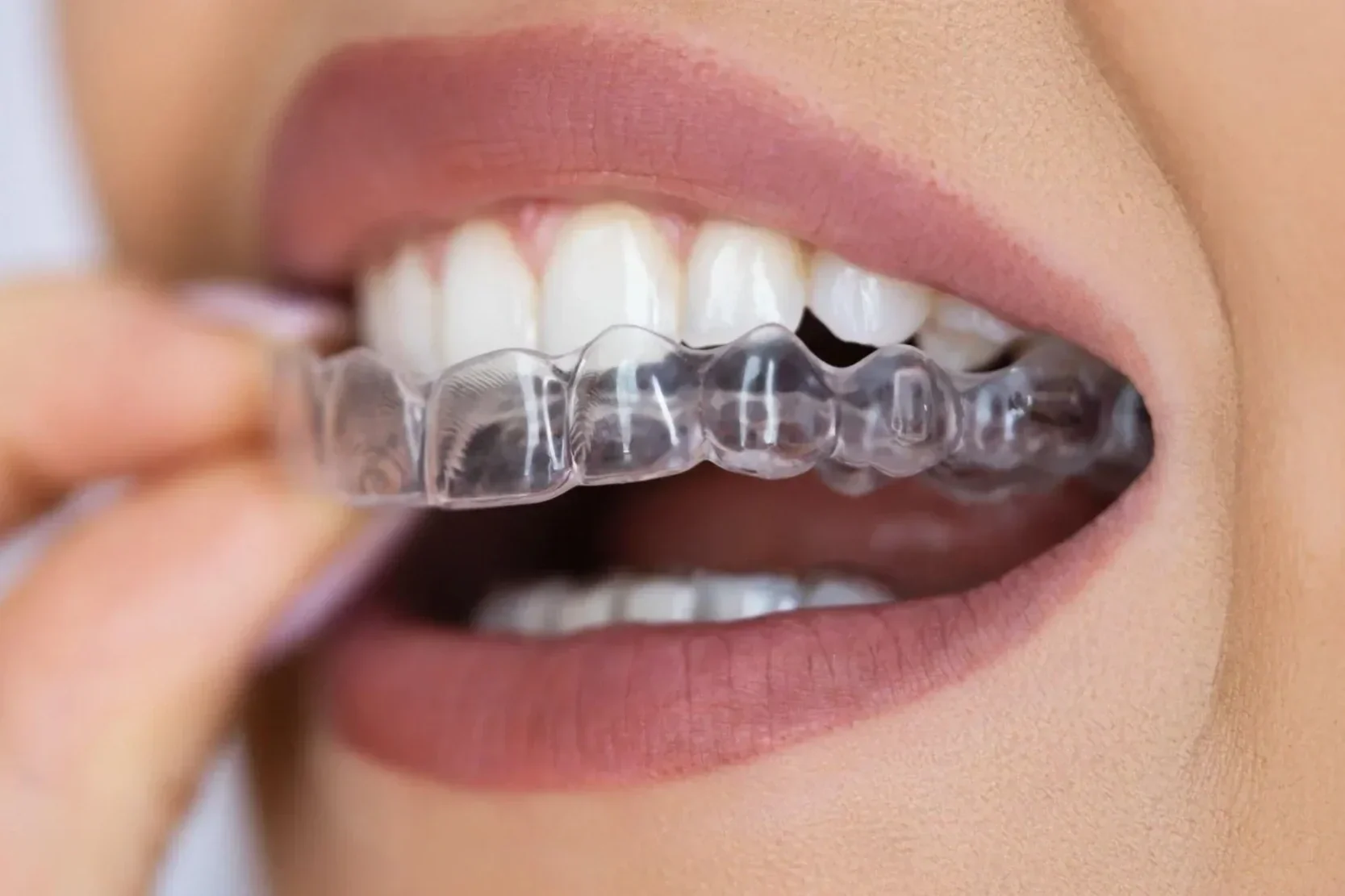 Close-up of a person placing a clear dental retainer in their mouth, showing teeth and lips.