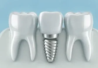 An image showing dental implant teeth