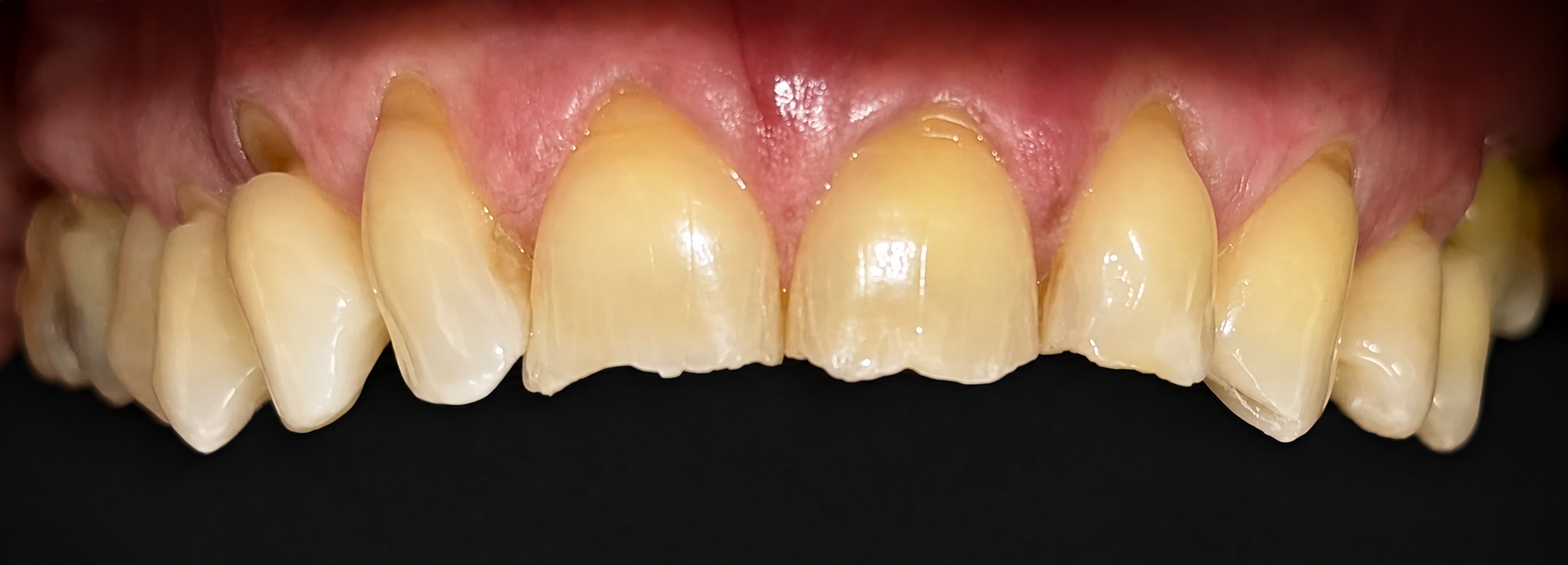 Close-up of yellowed, uneven front teeth with some chipping and plaque buildup.
