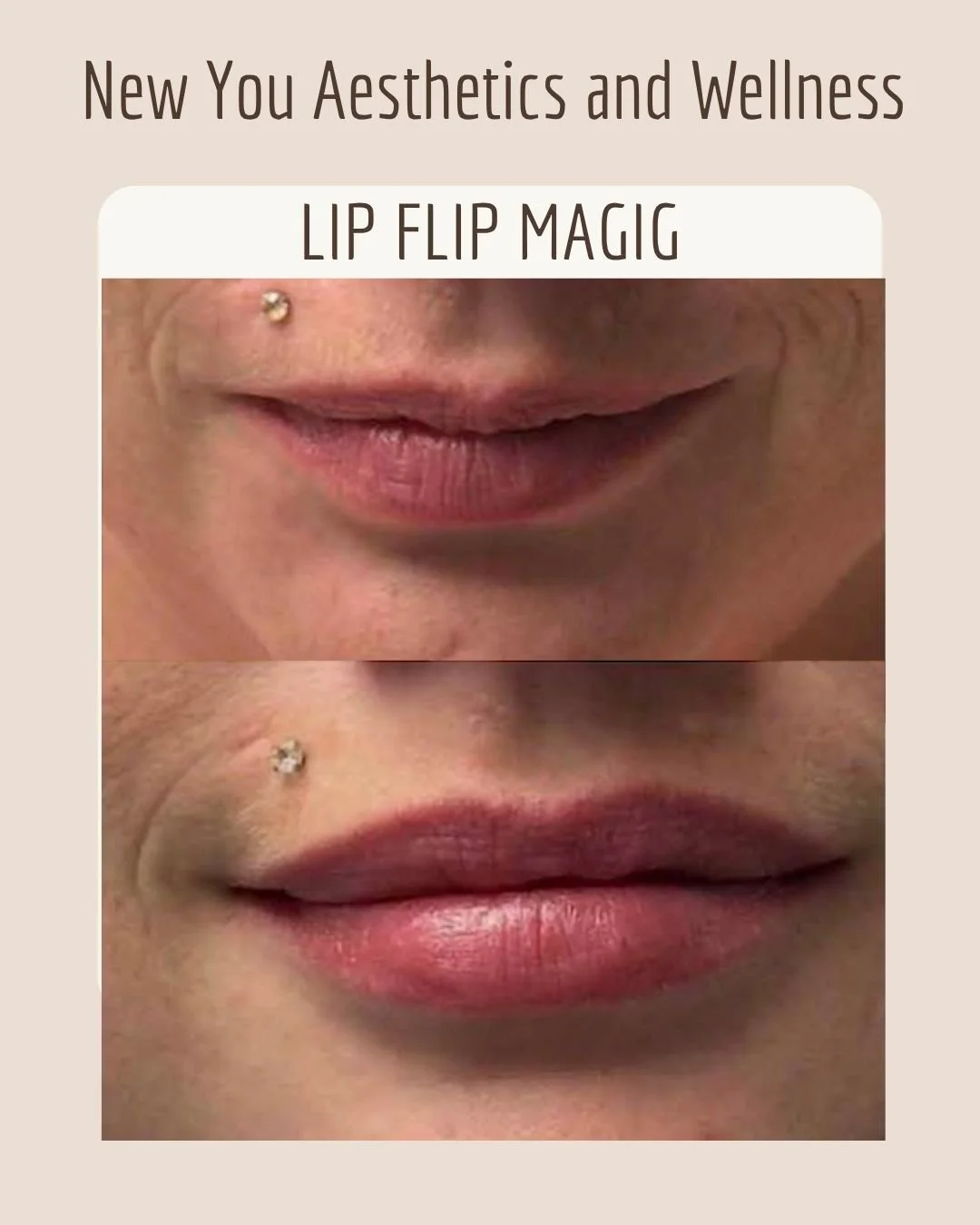 lip flip before and after - Paula Severns.jpg