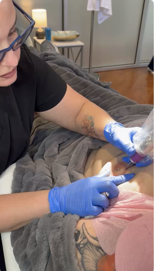 Bilateral 3D Areola Restoration