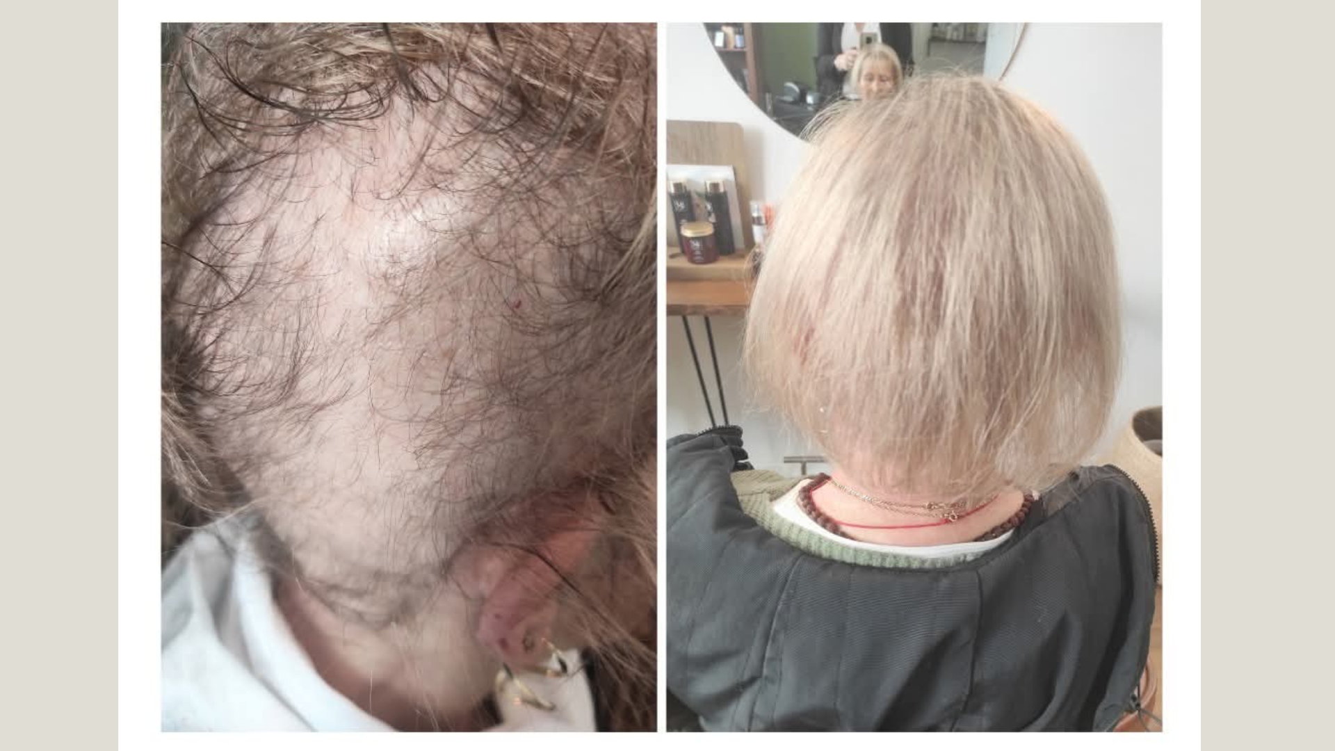 alopecia-treatment-hair-growth.jpg