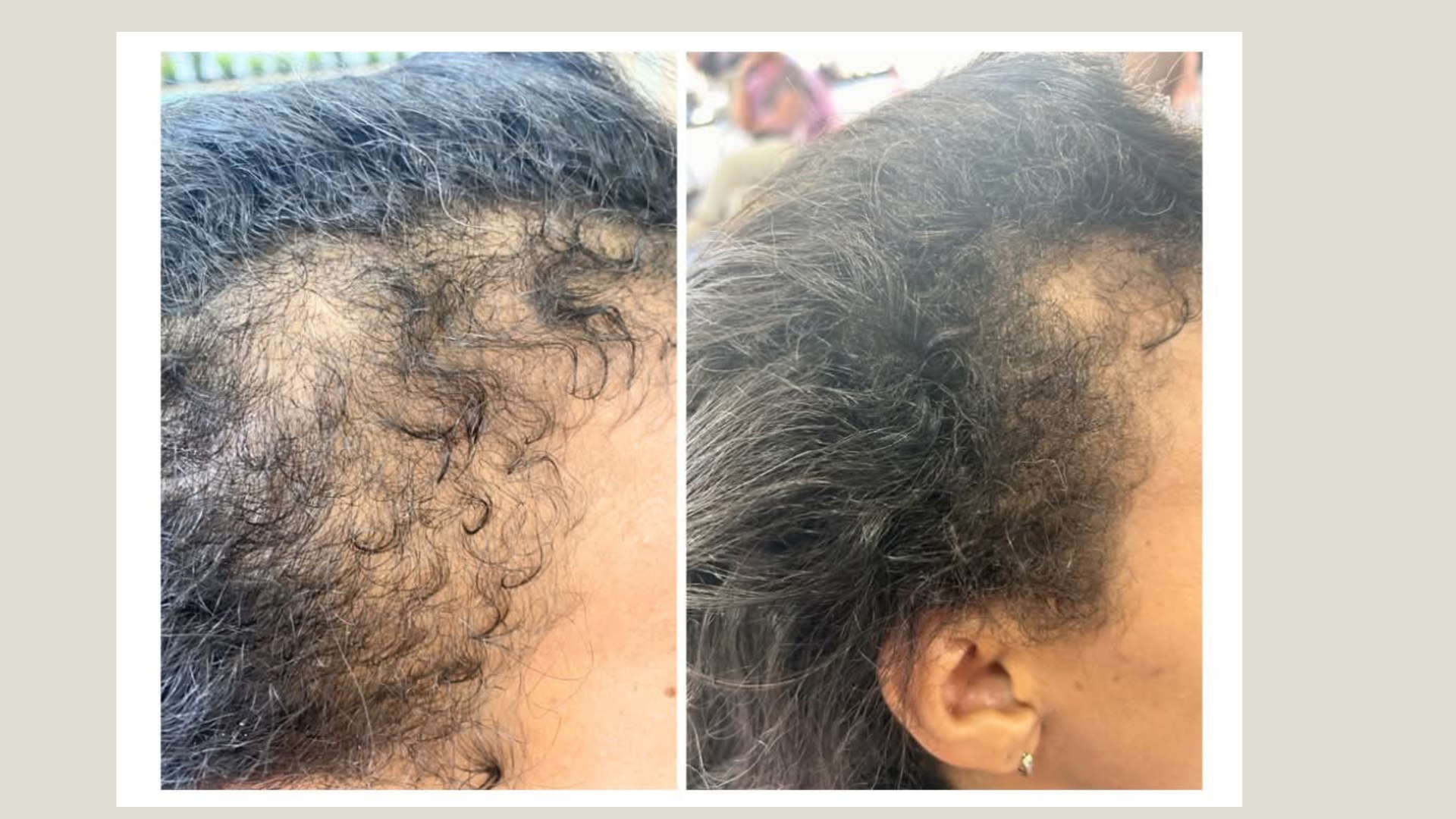 post-partum-hair-loss.jpg