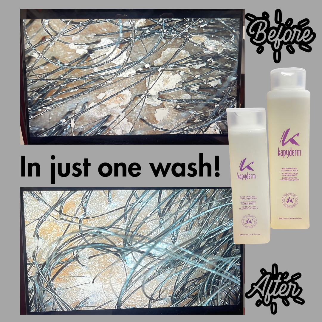 scalp-cleanse-seborrheic-dermatitis.jpg