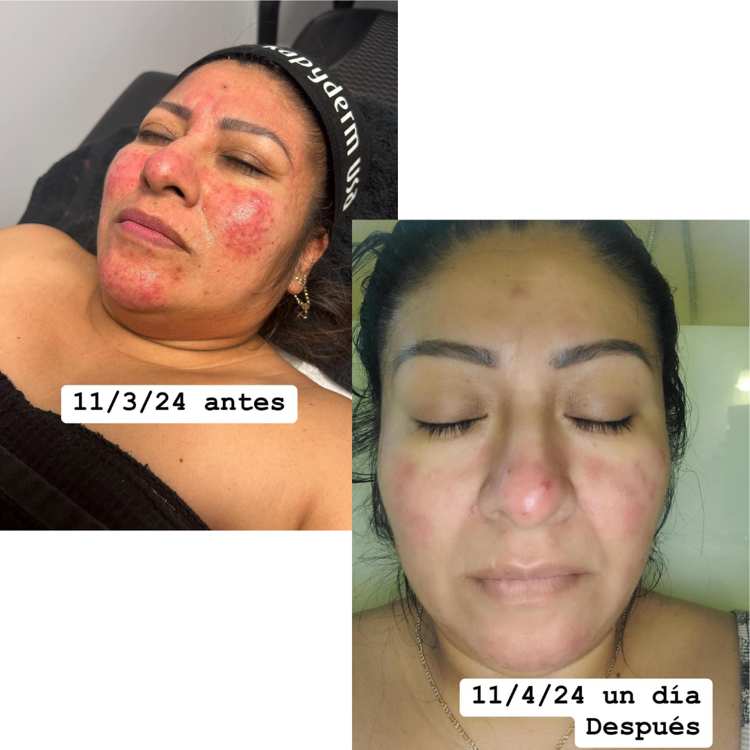 rosacea-facial-before-after-kapyderm.jpg