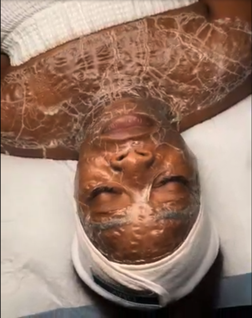 Close-up of a person's face covered with a specialized facial mask, lying on a white pillow with a towel behind their head.