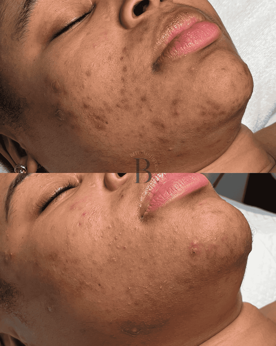 Close-up of a person's face before (top) and after (bottom) skin treatment showing reduction in acne and blemishes.