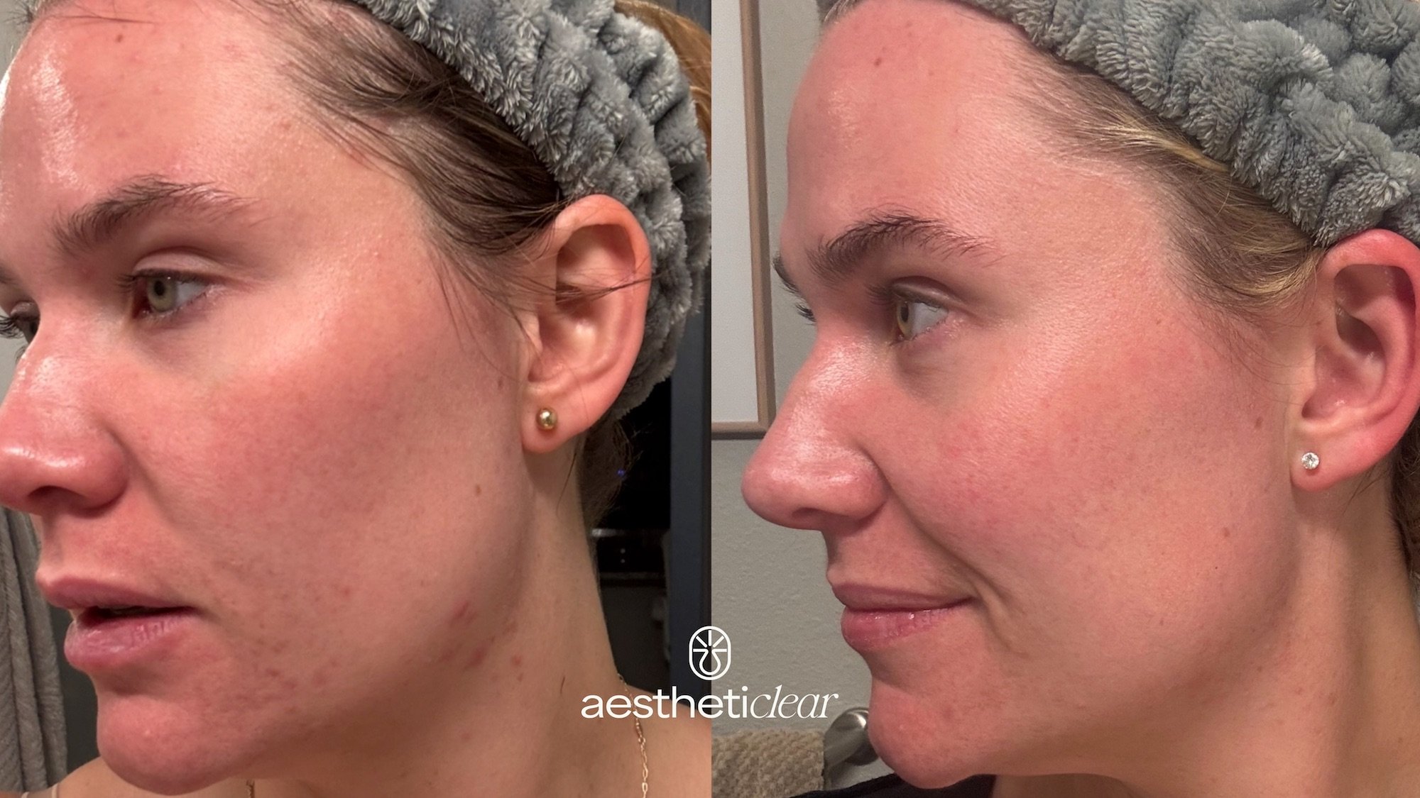 acne treatments near me