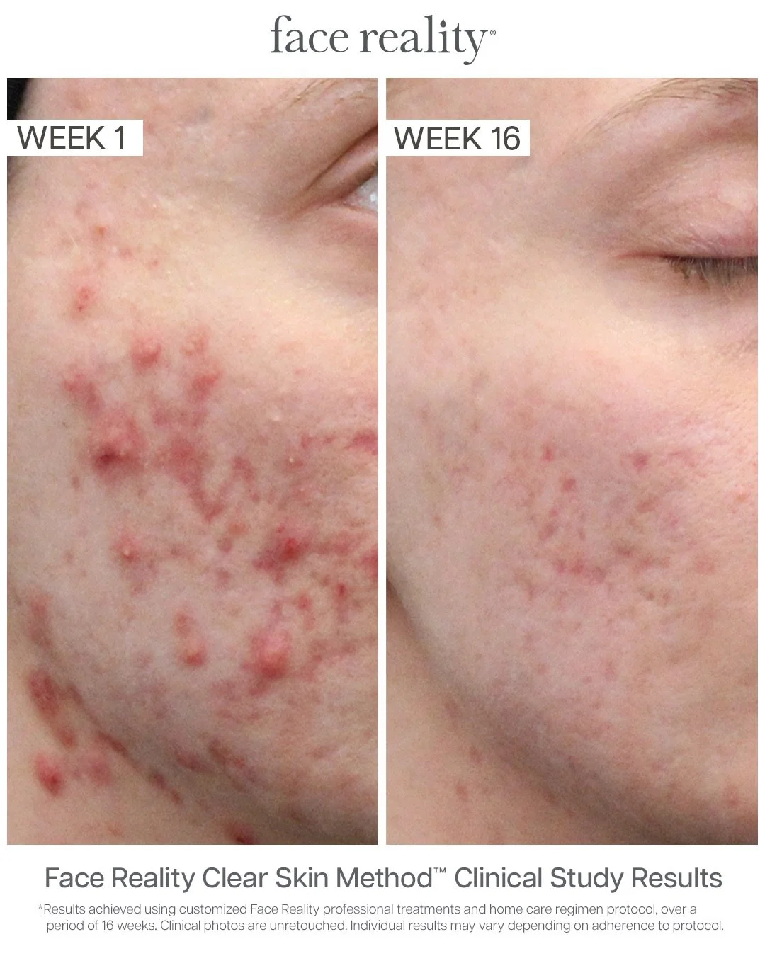 chemical peels in centennial