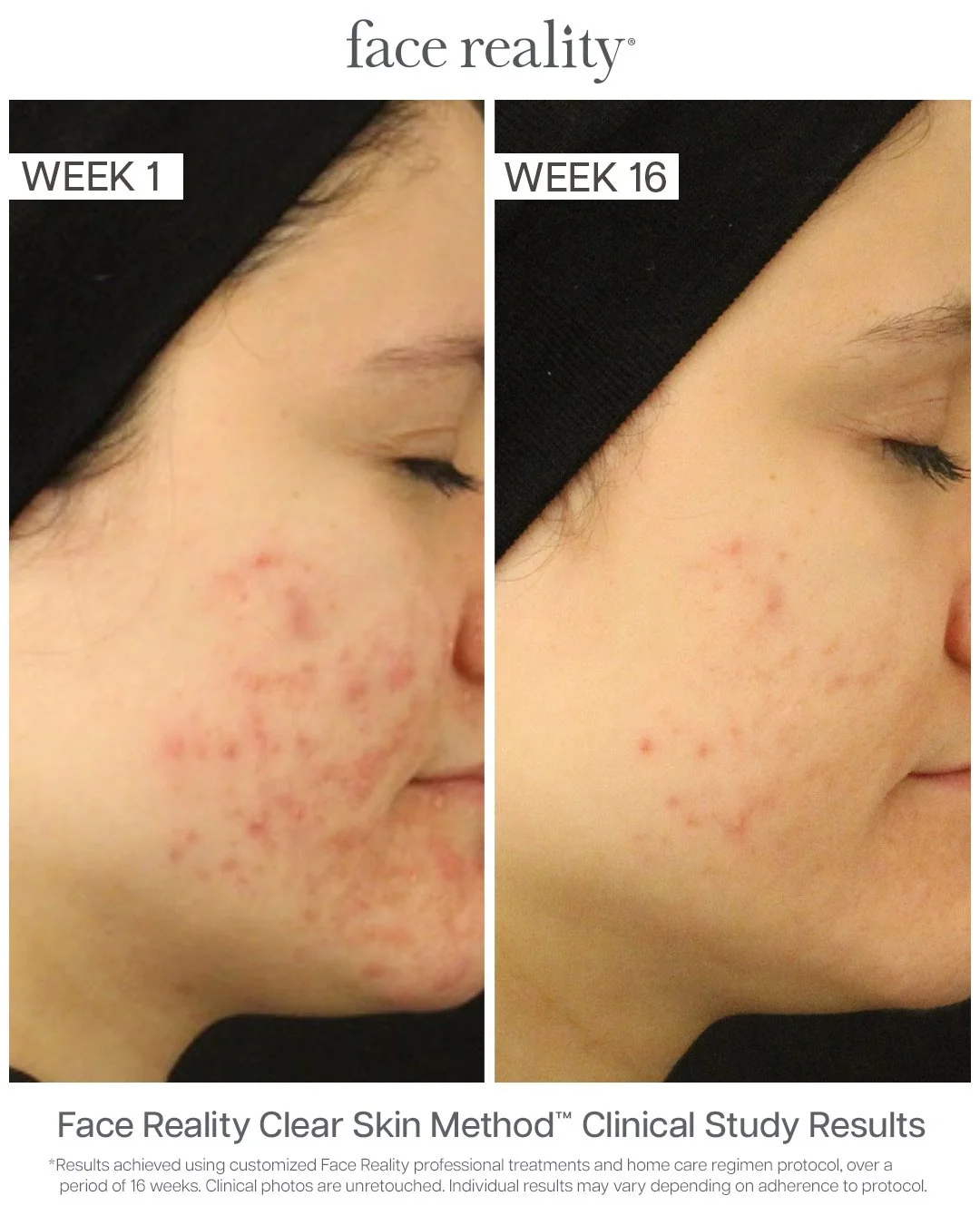 acne facials centennial
