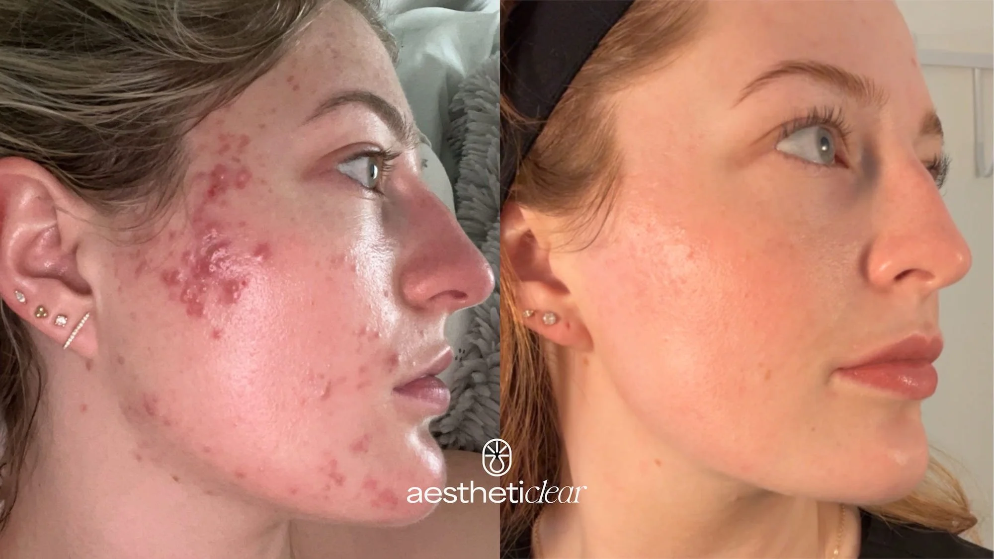 acne treatments near me, acne treatments centennial, CO