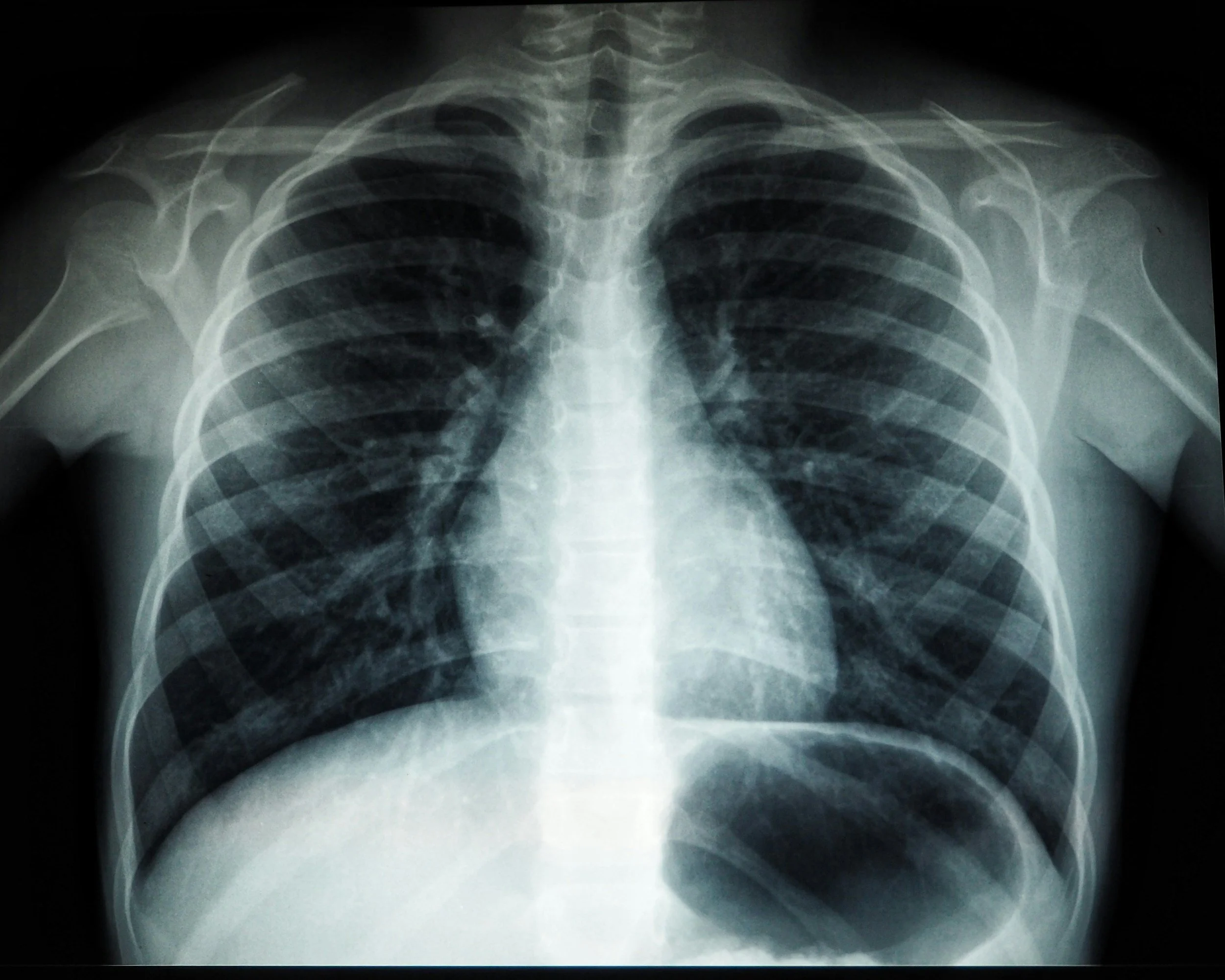 A Gorilla in the Scan