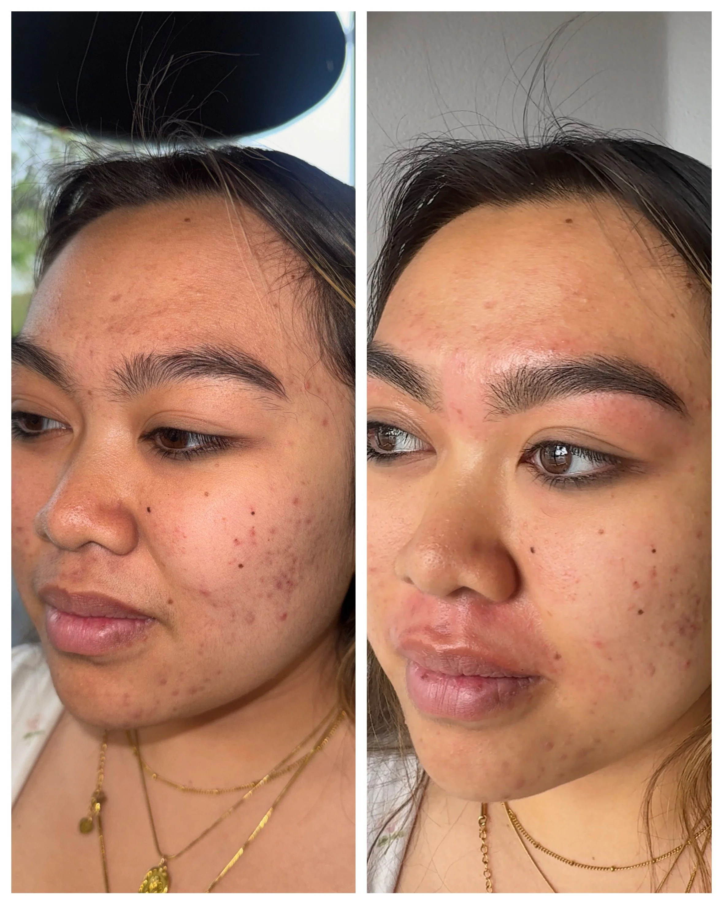 Side-by-side comparison of a woman's face before and after skincare treatment, showing improved skin texture and reduced blemishes.