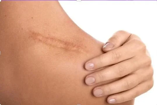 Scar tissue massage at the vibration station at Unwind - Body & Mind