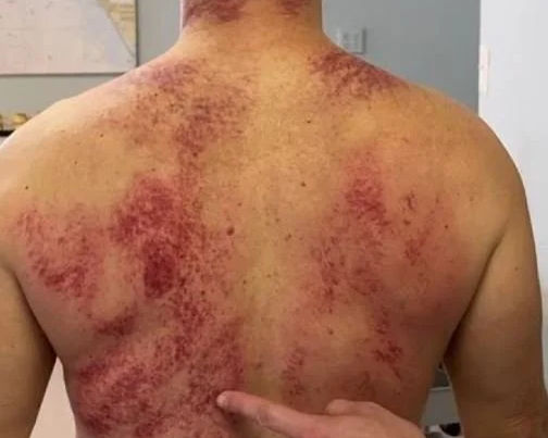 Gua Sha