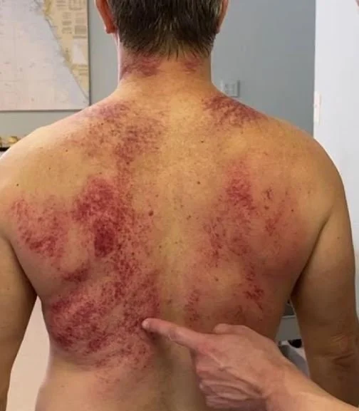 Gua Sha petechia marks