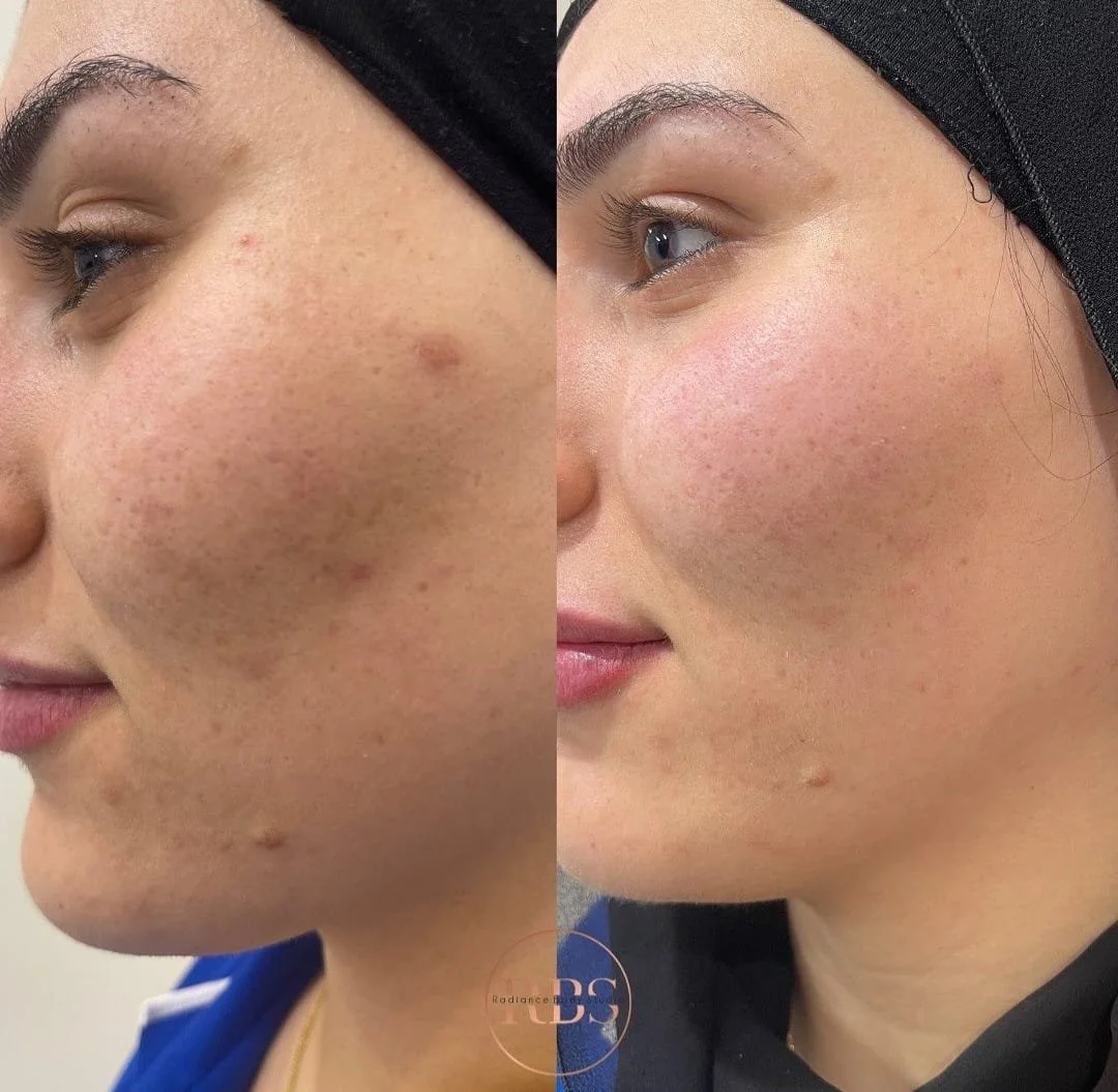 Side-by-side comparison of a woman's face showing skin clear improvement, with before and after images highlighting reduced acne scars and redness.