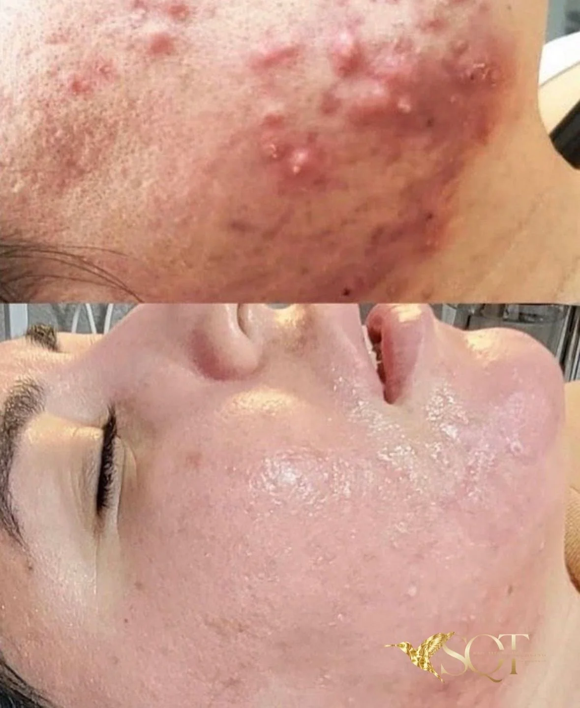 Comparison of a person's skin before and after skincare treatment, showing improved skin condition and reduced acne.