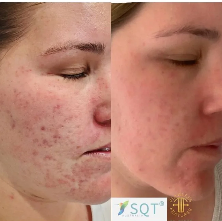 Side-by-side comparison of a woman's face showing skin improvement; before image on the left with acne scars and redness, after image on the right with clearer skin.