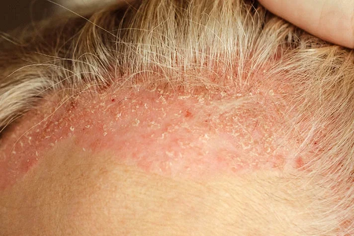 Close-up of a person's scalp showing dry, flaky, and irritated skin at the hairline.