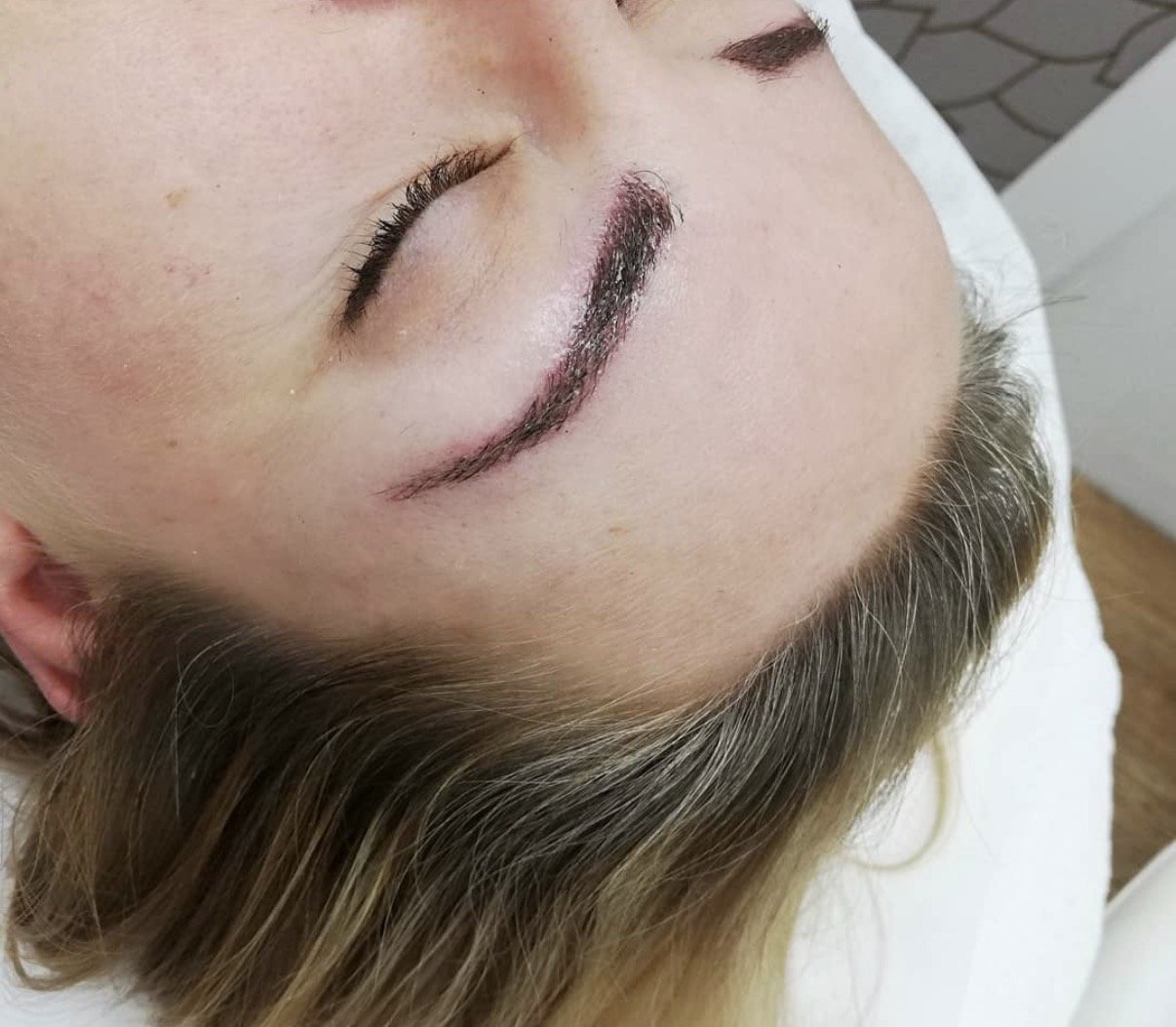 Close-up of a person's face with fresh surgical stitches above the eyebrow, healing from a procedure.
