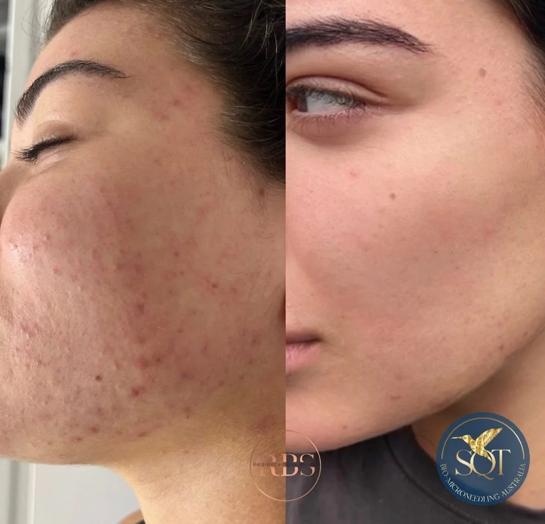 Side by side comparison of a woman's face showing significant improvement in skin smoothness and reduction of acne scars.