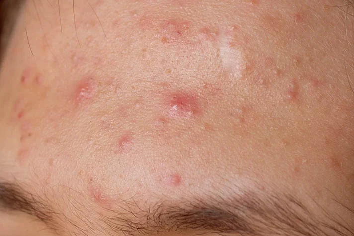 Close-up of a person's forehead showing multiple small red pimples and acne spots.