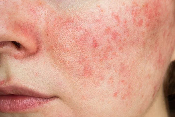 Close-up of a person's face showing facial redness and irritation, particularly on the cheek.