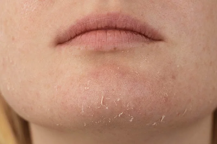 Close-up of a person's lower face showing lips and chin with dry, peeling skin.