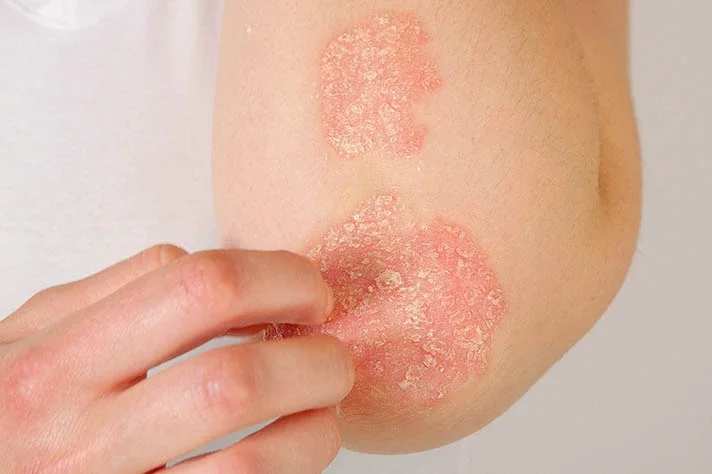 Close-up of a person's knee with dry, flaky skin and peeling patches, being gently scratched by their hand.